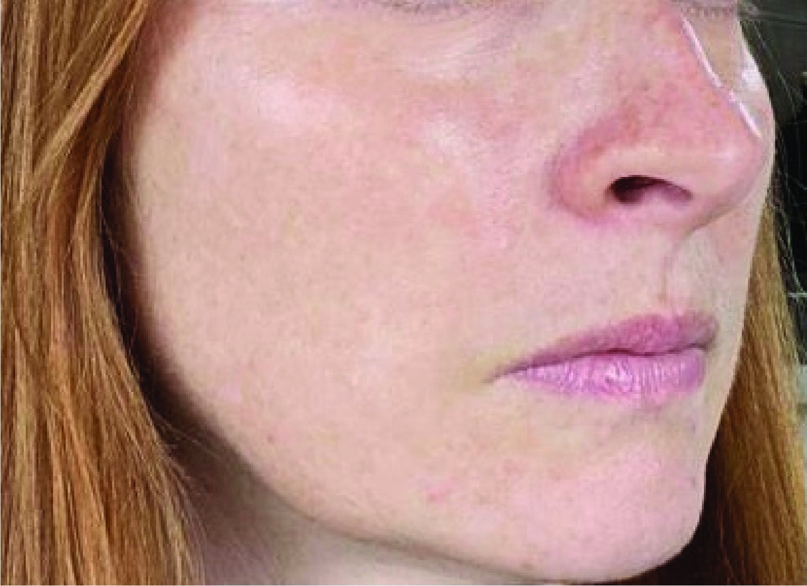 After Dermal Filler Treatment