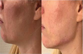 Before Dermal Filler Treatment